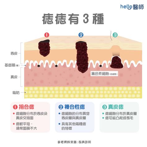 臉部有痣|痣變大、痣多或長毛會變皮膚癌？認識痣的形成與原因